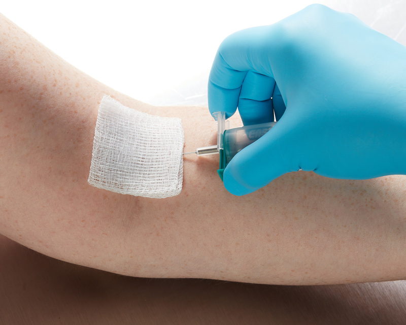 EPBCP-venipuncture-Pre